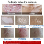 Portable 311nm UVB Phototherapy Lamp Home Treatment for Psoriasis, Vitiligo & Eczema
