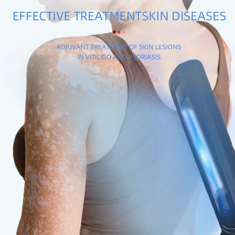 Portable Narrowband UVB Phototherapy Lamp with Digital Timer 311nm Home Treatment Device