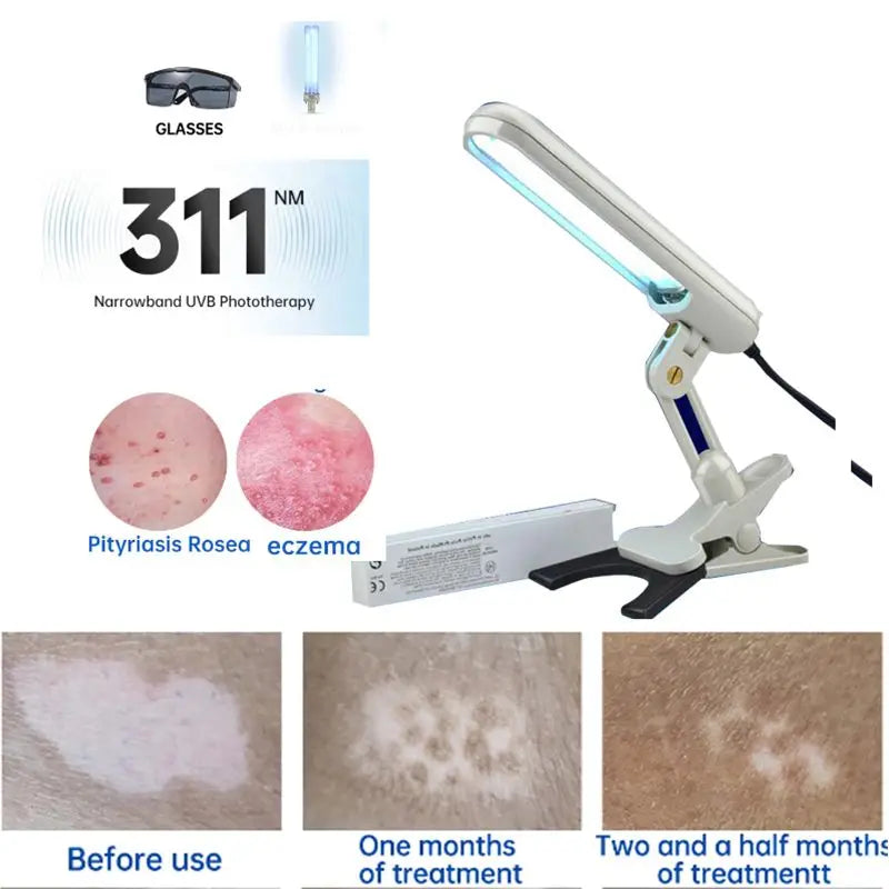 Rechargeable UVB 311nm Skin Treatment Lamp Home Light Therapy for Psoriasis AU Plug
