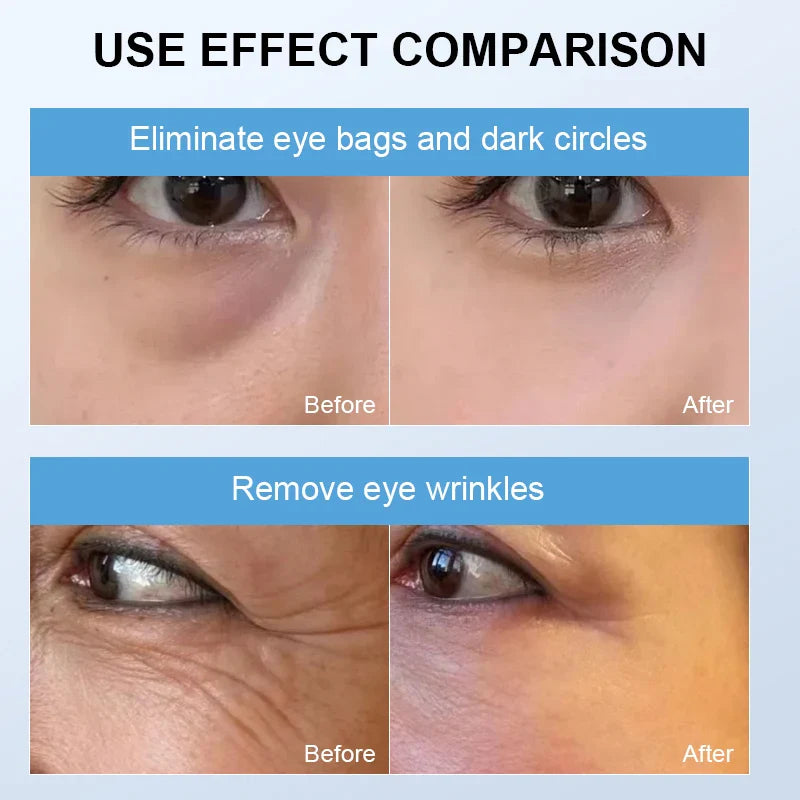 Portable Eye Therapy Device for Wrinkles, Puffiness, Dark Circles