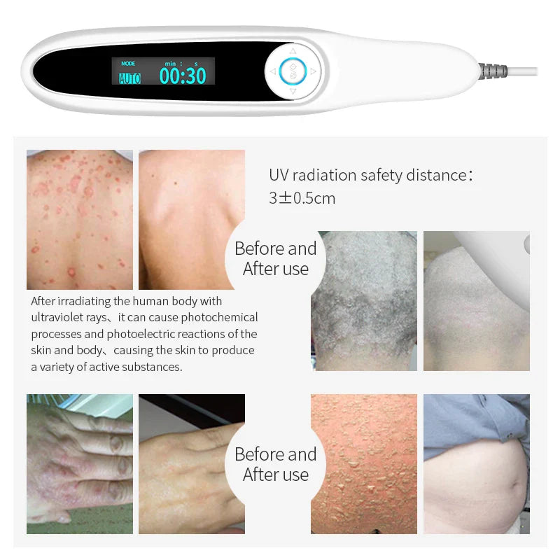 Home Use 311nm UVB Light Therapy Device 220V AU Plug