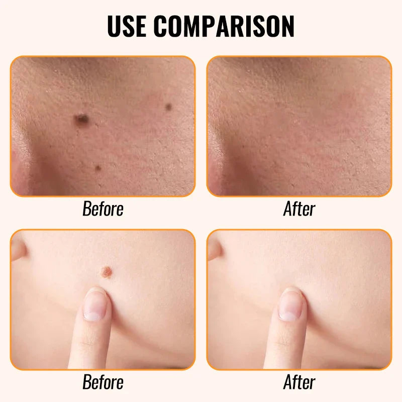 Mini Laser Plasma Mole Remover Pen with Box – Skincare Tool