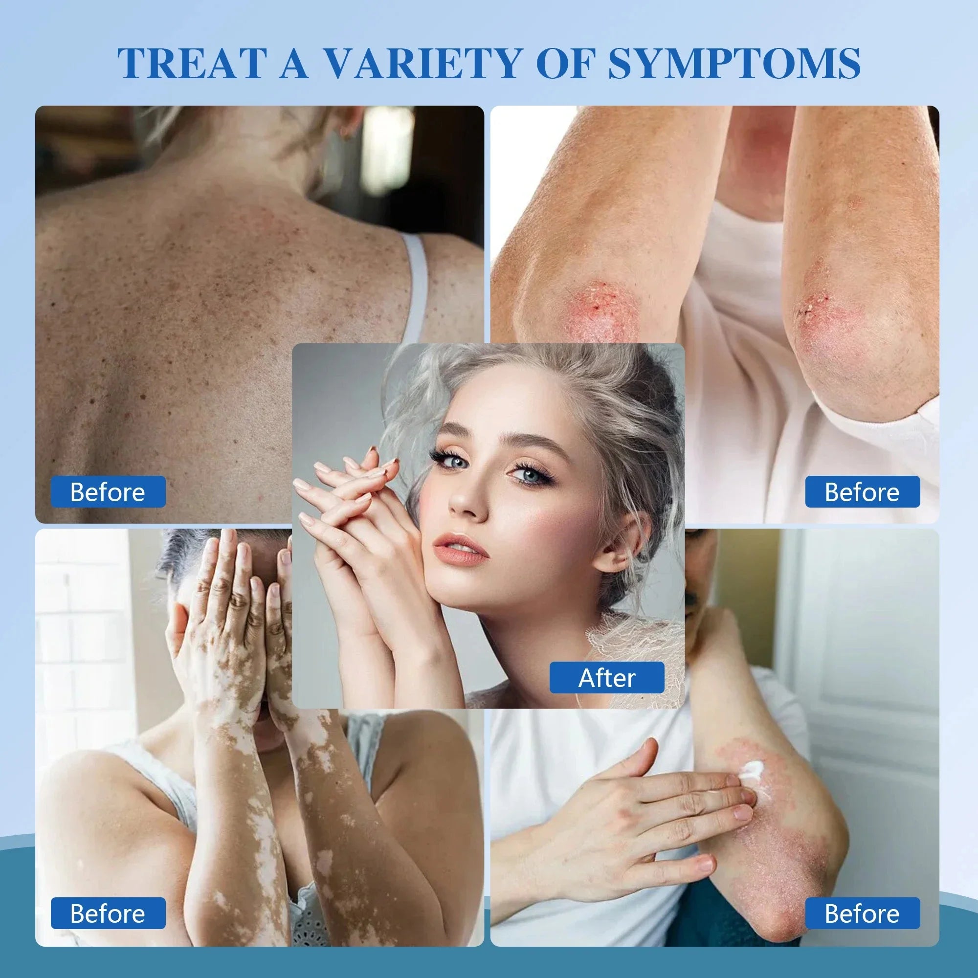 Portable 311nm UVB Phototherapy Device for Skin Treatment
