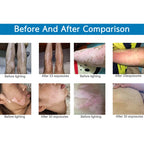 Handheld 311nm UVB Phototherapy Lamp Treat Psoriasis, Eczema & Vitiligo at Home 220V AU
