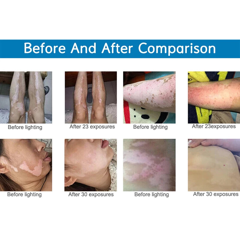 Handheld 311nm UVB Phototherapy Lamp Treat Psoriasis, Eczema & Vitiligo at Home 220V AU