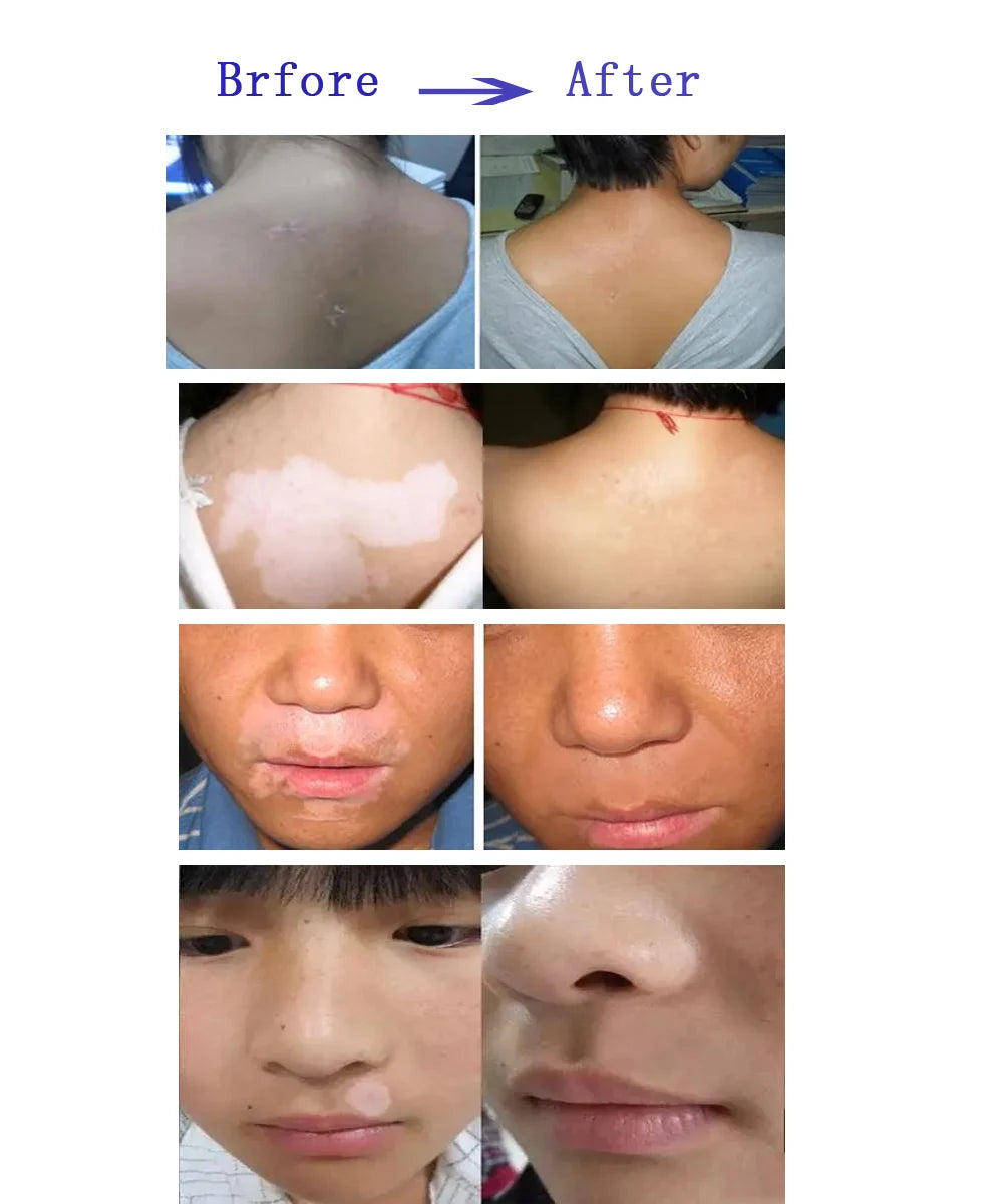 Handheld 311nm UVB Phototherapy Lamp Treat Psoriasis, Eczema & Vitiligo at Home 220V AU