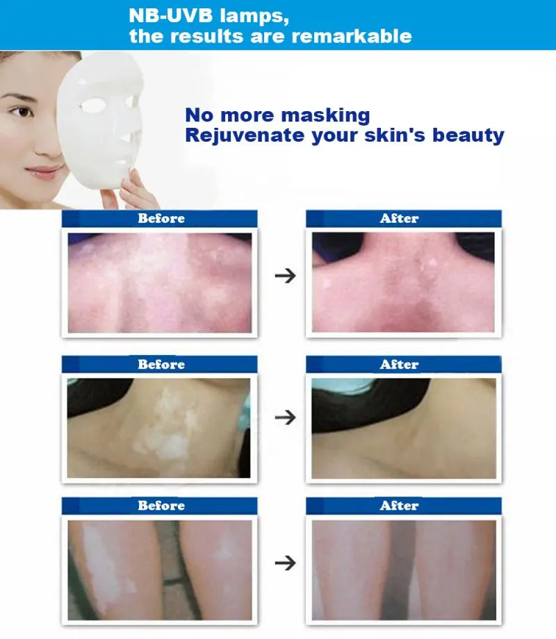 Rechargeable UVB 311nm Skin Treatment Lamp Home Light Therapy for Psoriasis AU Plug